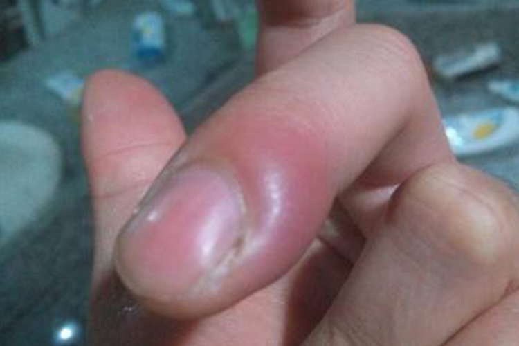 甲沟炎指甲根部鼓包图