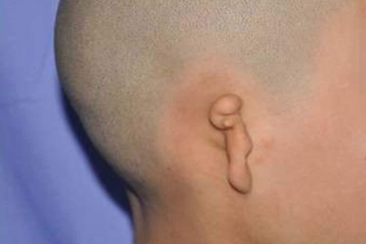 小耳畸形2度图