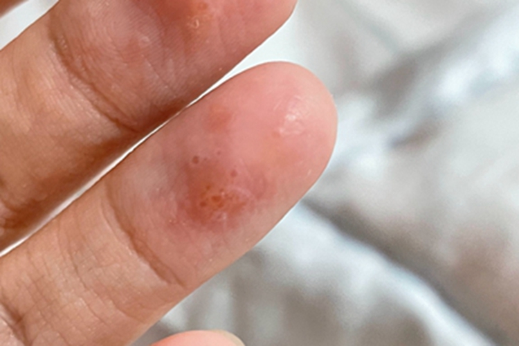 汗疱疹手指尖症状图