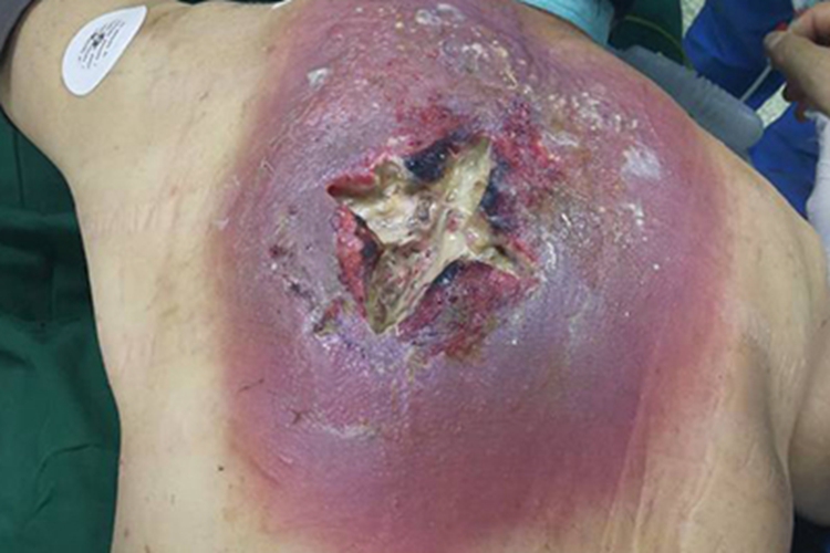 坏疽性蜂窝织炎背部症状图 坏疽性蜂窝织炎背部症状图