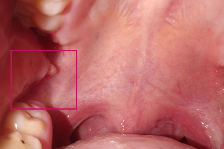 颊部内侧黏液腺囊肿图 颊部内侧黏液腺囊肿图