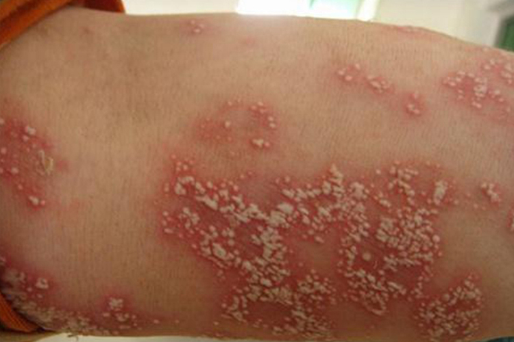 脓疱型银屑病图