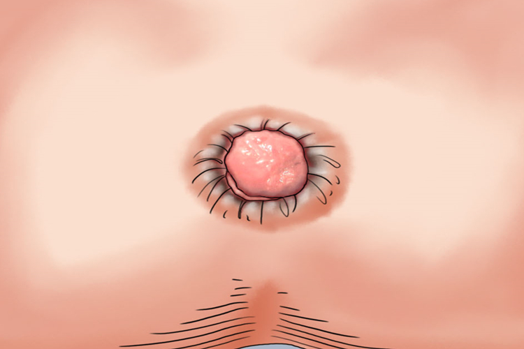 内痔结节手绘图 内痔结节手绘图