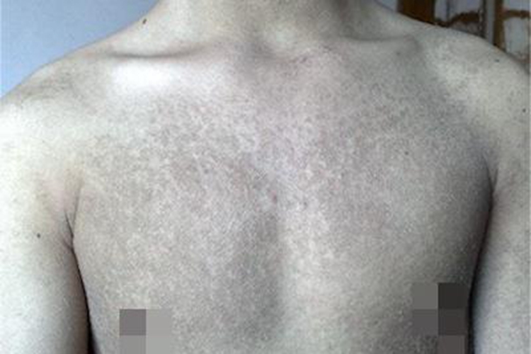 鱼鳞病胸部症状图