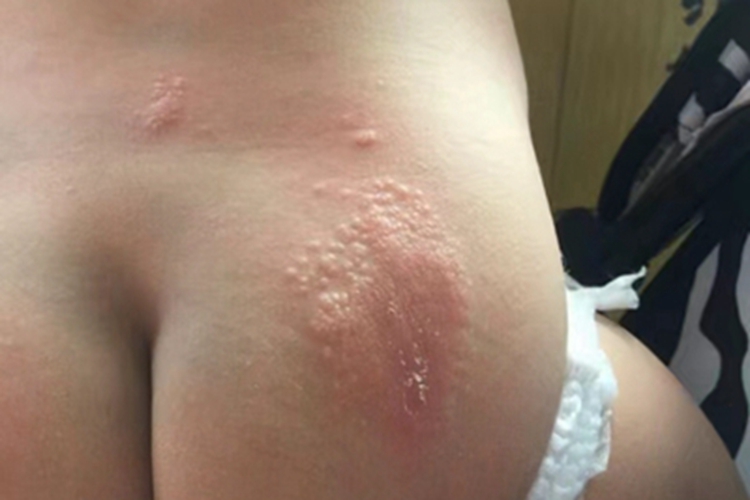 急性湿疹臀部症状图