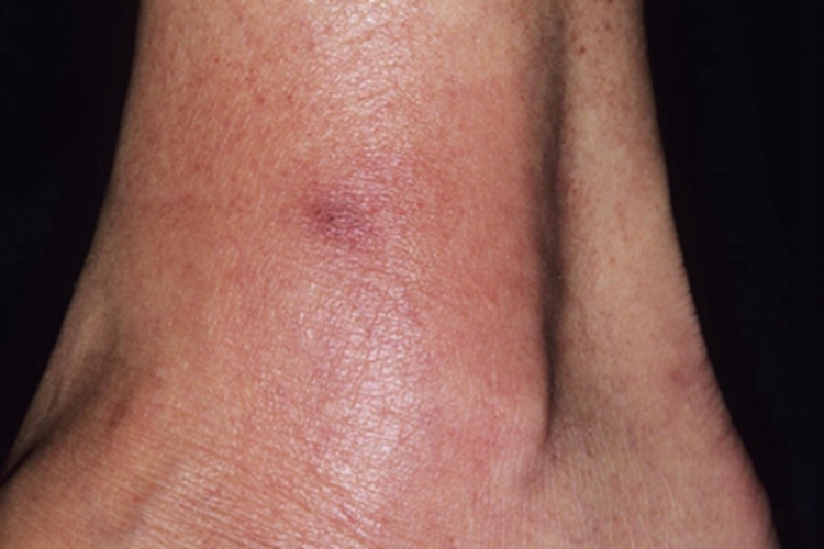 蜂窝织炎脚踝红肿图 蜂窝织炎脚踝红肿图