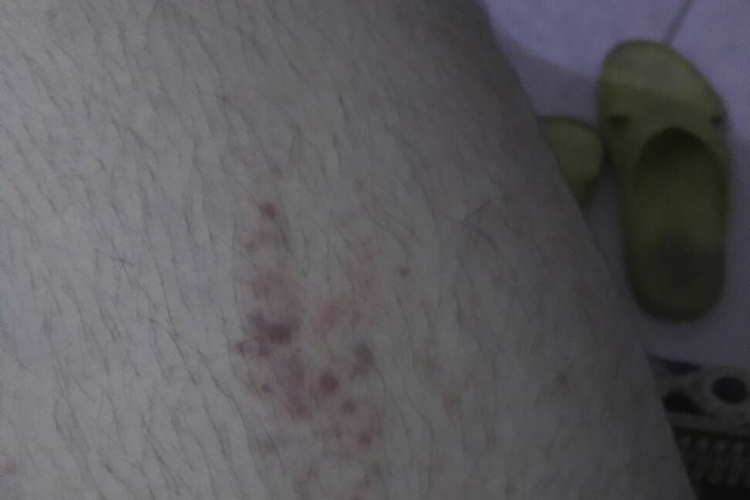 大腿内侧色素沉着图 大腿内侧色素沉着图