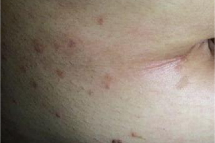 体虱病右腹症状图