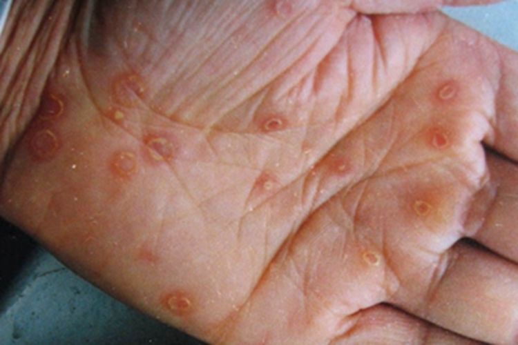 三期梅毒手部症状图