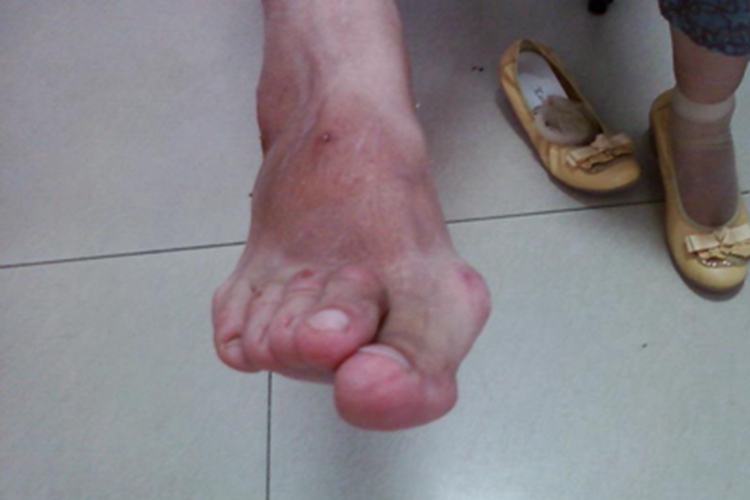 费尔蒂综合征脚趾畸形图