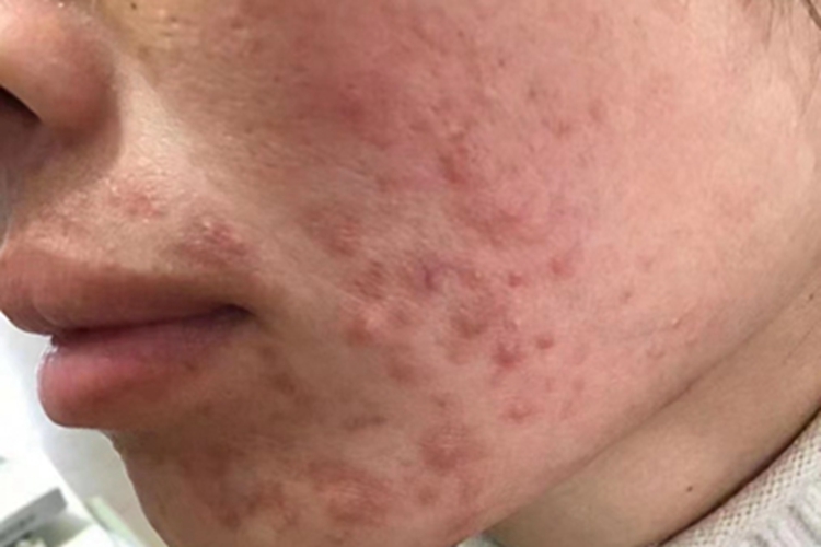 痤疮脸上有很多暗红小疙瘩图 痤疮脸上有很多暗红小疙瘩图