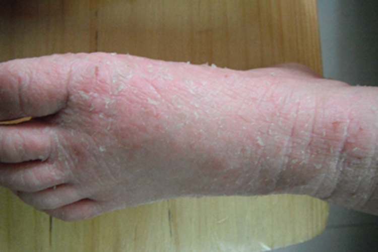 儿童期特应性皮炎脱皮图 儿童期特应性皮炎脱皮图