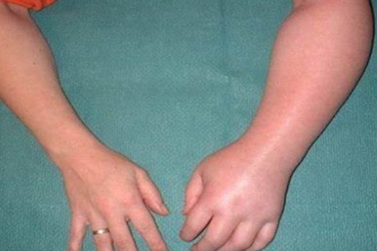 肩手综合征胳膊僵硬图 肩手综合征胳膊僵硬图