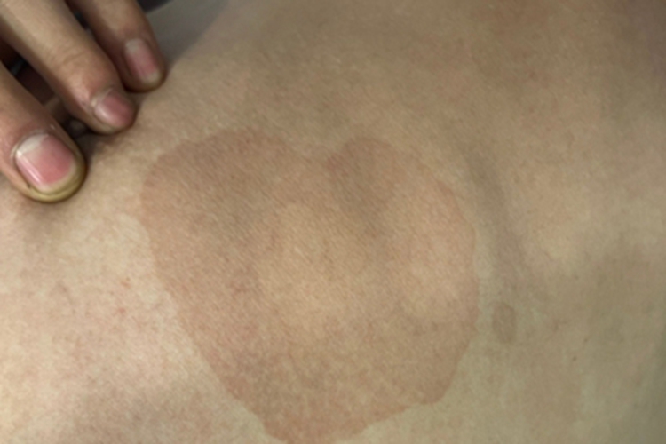 花斑癣大腿症状图