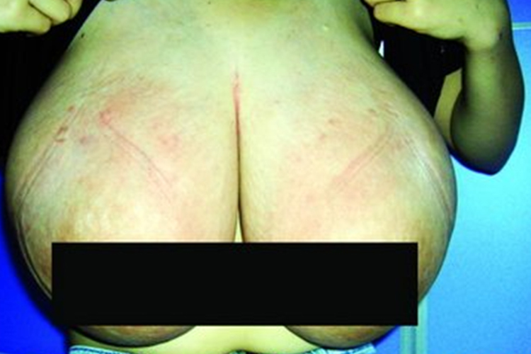 成年女性巨乳症图