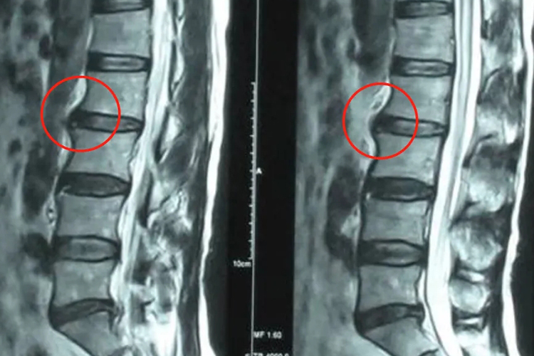 腰间盘内突影像图