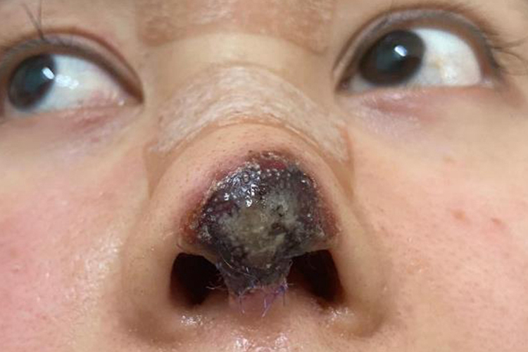 隆鼻术后鼻小柱发炎图 隆鼻术后鼻小柱发炎图