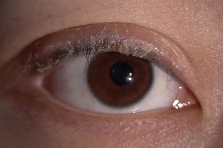 眼睫毛根部鳞屑型睑缘炎图