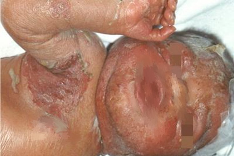 先天性梅毒皮疹图