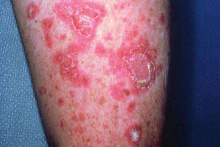 亚急性皮肤型红斑狼疮丘疹鳞屑图