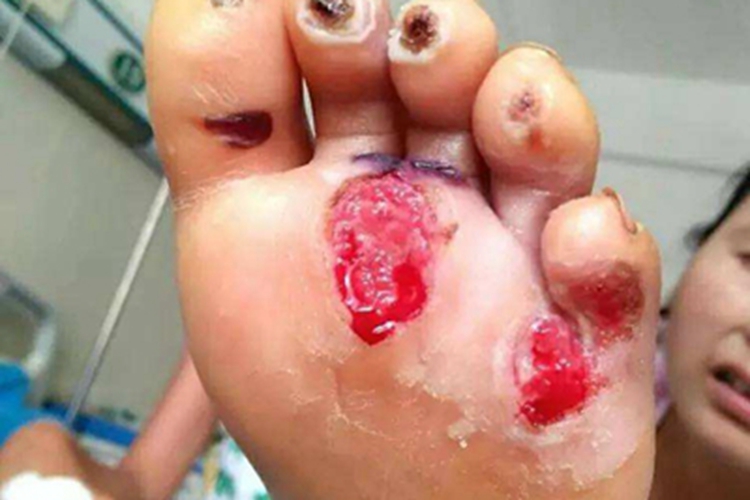 电弧烧伤脚底糜烂图