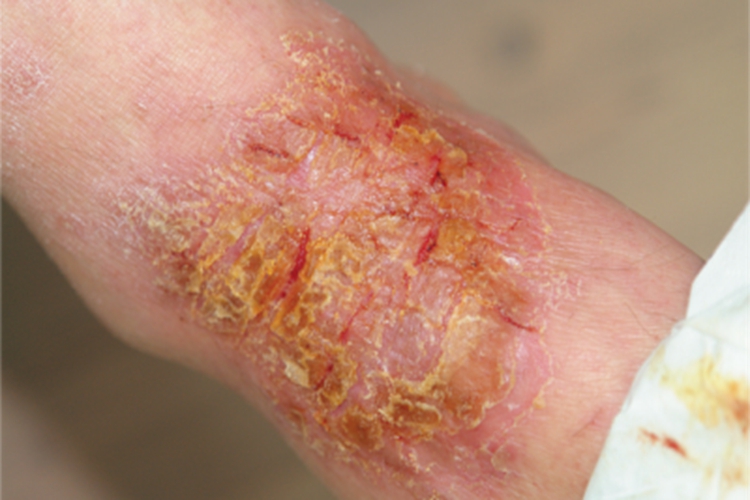 亚急性湿疹脚踝红肿图