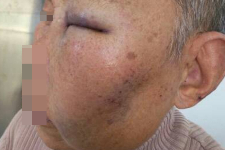 颧弓骨折M型外观图 颧弓骨折M型外观图