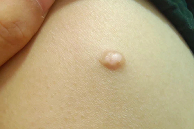 皮脂腺上皮瘤结节图