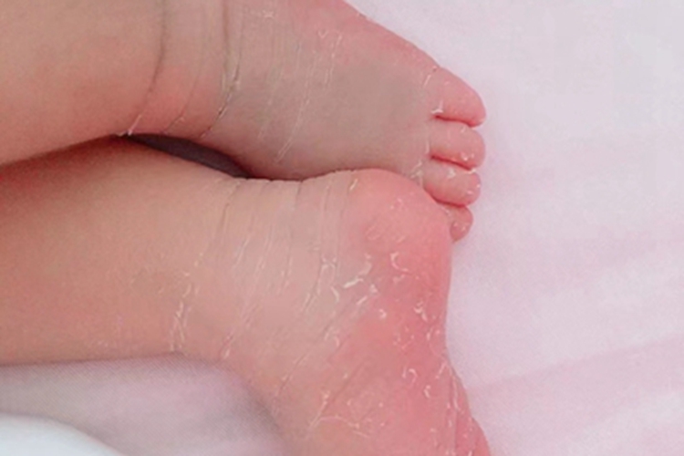维生素A过多症脚底脱屑图 维生素A过多症脚底脱屑图