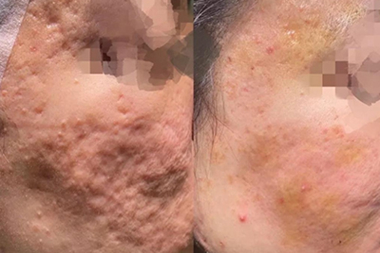 人工真皮填充痘印效果图 人工真皮填充痘印效果图