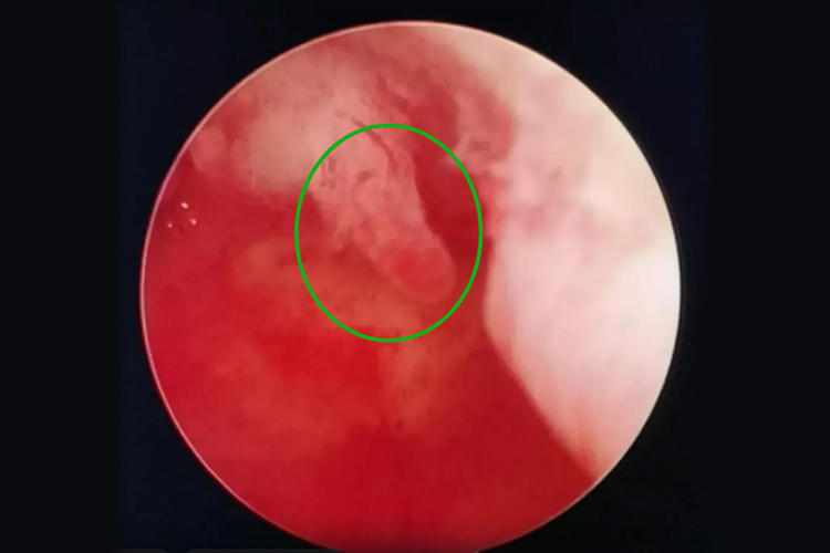 子宫息肉较小图