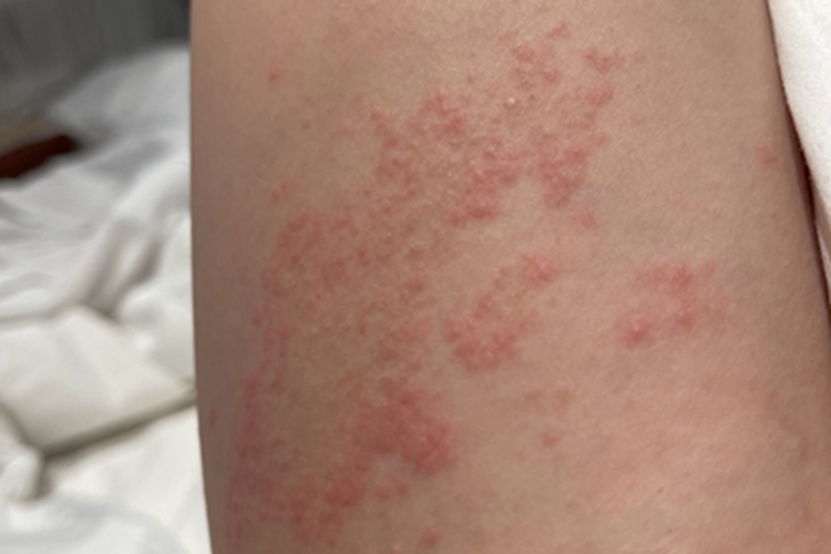 急性接触性皮炎小腿红斑丘疹图