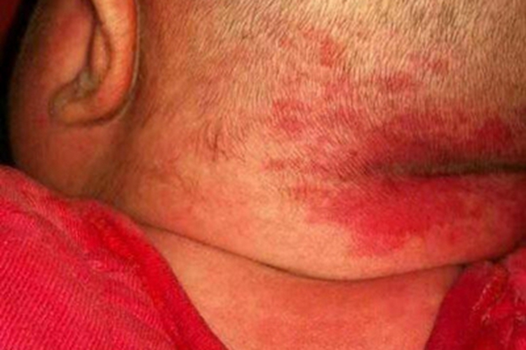 鲜红斑痣头皮症状图