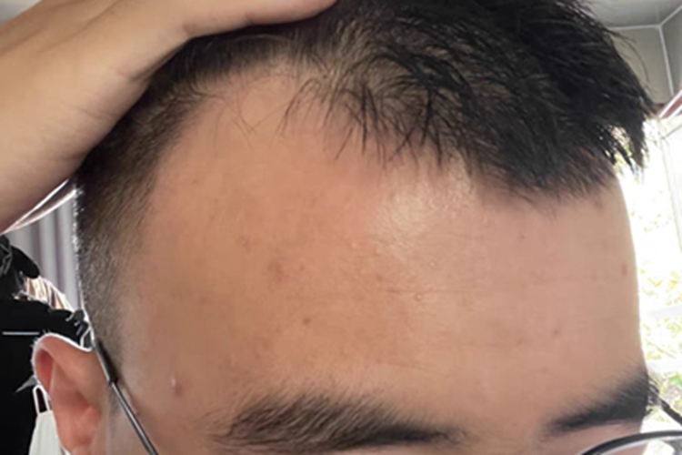 雄激素性脱发额角头发没了图