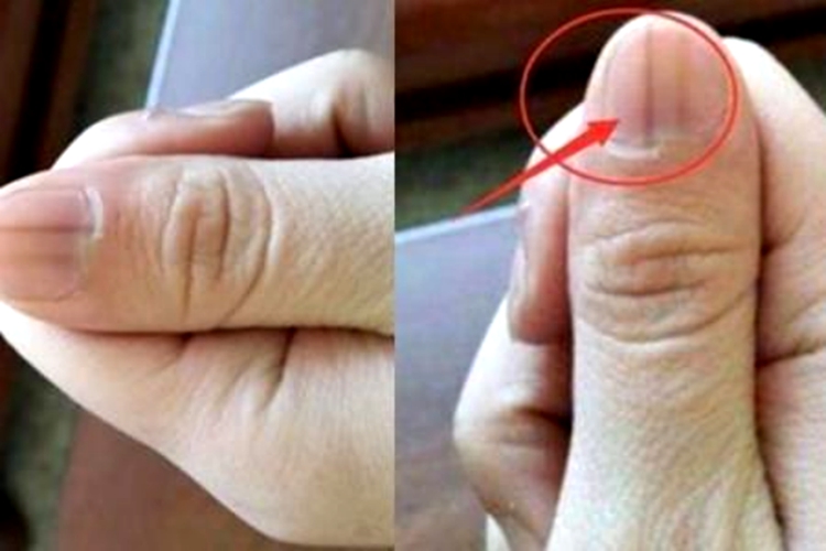 指甲上有黑色竖纹图