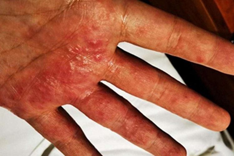 手部湿疹手掌起红疙瘩红斑图