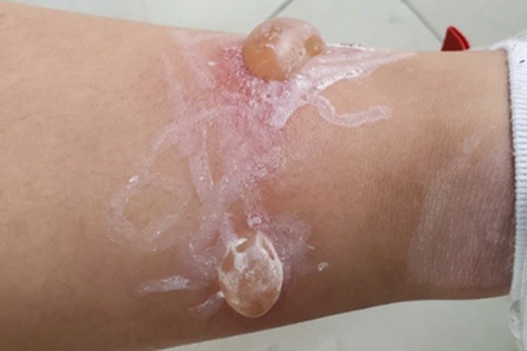 甲虫皮炎小腿多发大水疱图 甲虫皮炎小腿多发大水疱图