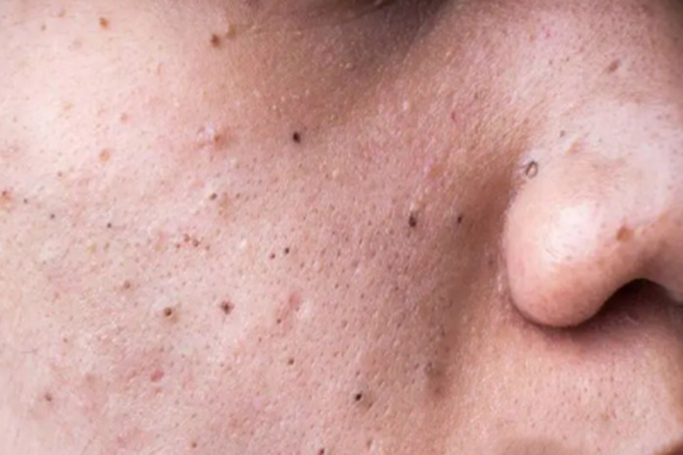 扩张孔面部黑点图