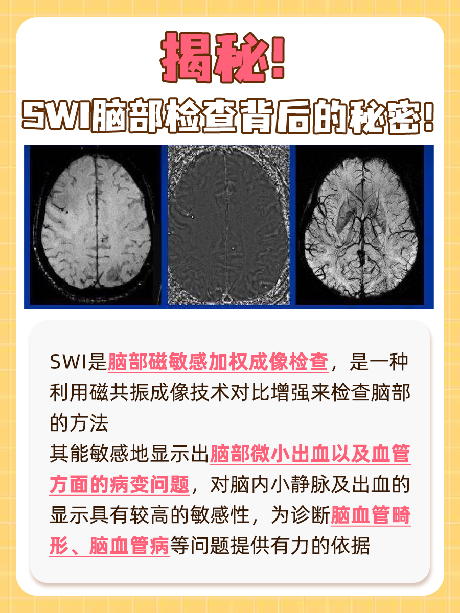 医生带你了解SWI：脑部检查的新体验！
