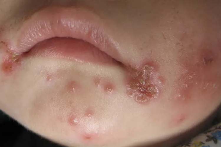 疱疹性湿疹水疱图 疱疹性湿疹水疱图