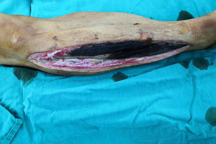 小腿肌肉坏死图