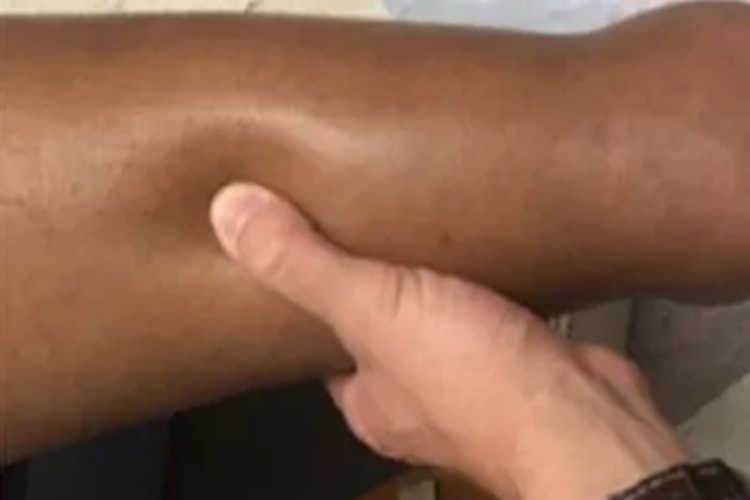 黏液性水肿小腿症状图