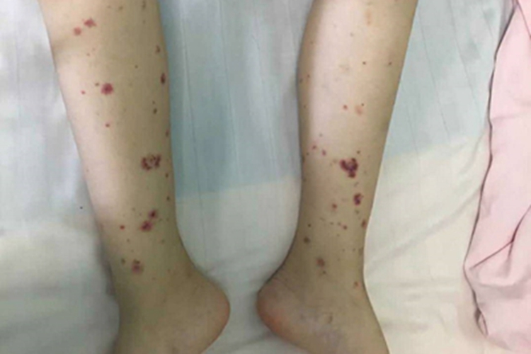 单纯性紫癜小腿症状图 单纯性紫癜小腿症状图