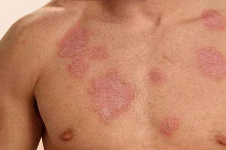 红斑狼疮圆形红斑图