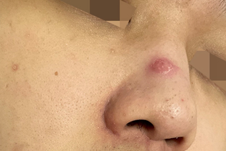 蜂蜇伤鼻部症状图