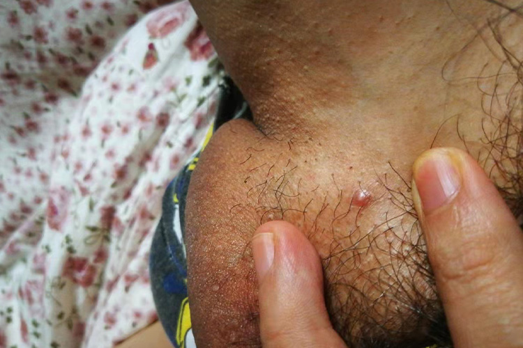 阴囊毛囊炎红色丘疹图 阴囊毛囊炎红色丘疹图