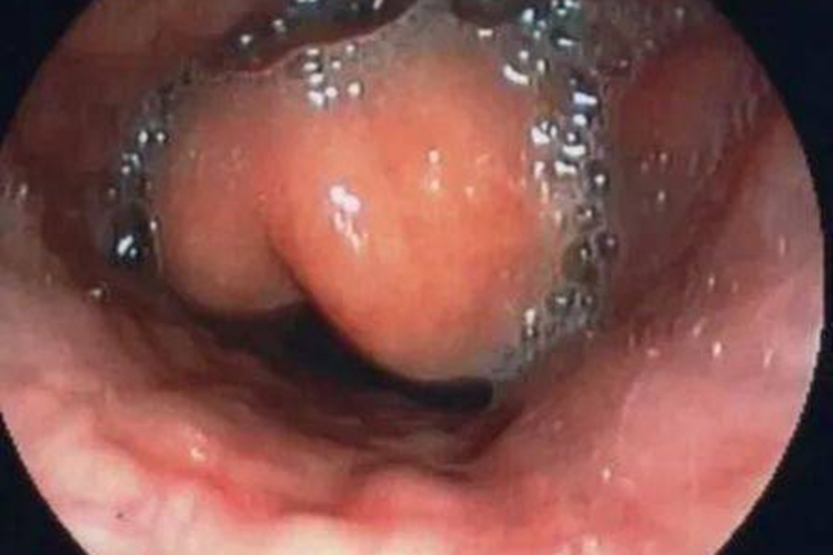 急性会厌炎会厌肿胀呈球形图