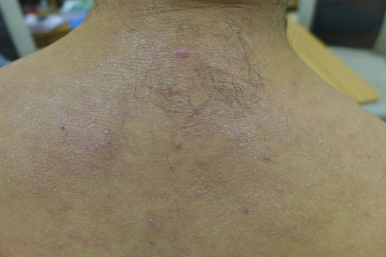 后背局限性神经性皮炎图