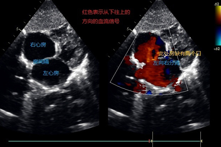 房间隔缺损彩超图
