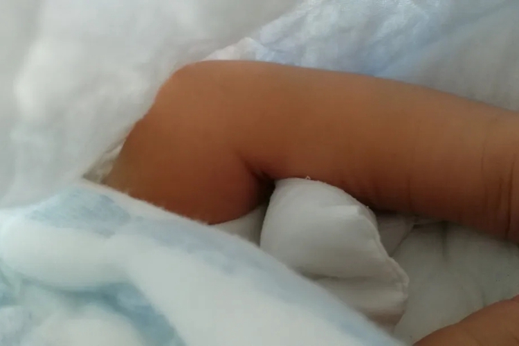 髌骨脱位膝盖伸不直图